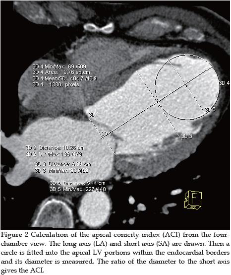 Cardiac CT for Assessment of Myocardial Geometry before and after Surgical Repair of Apical Left ...
