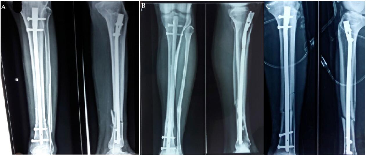 Intramedullary Interlocking Nail in Distal One Third Tibia Fracture: A  Retrospective Study in Tertiary Care Center | Baral | International Journal  of Orthopaedics
