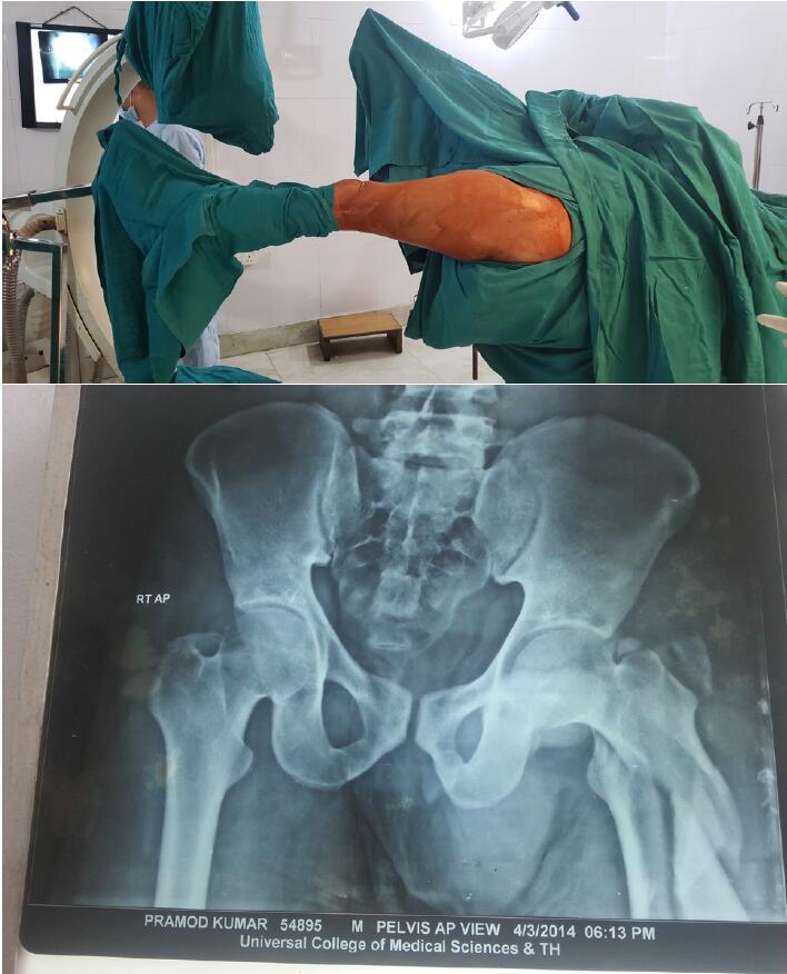 Retrospective Study Of Proximal Femoral Nail In Management Of Unstable  Trochanteric Fractures Of Femur | Kandel | International Journal of  Orthopaedics