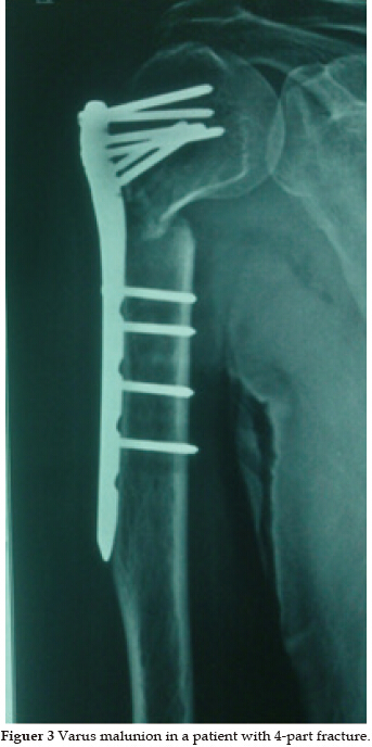 PHILOS plate in Proximal Humerus Fracture – its functional outcome and