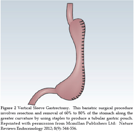 Case study gastric bypass and alcoholism loss