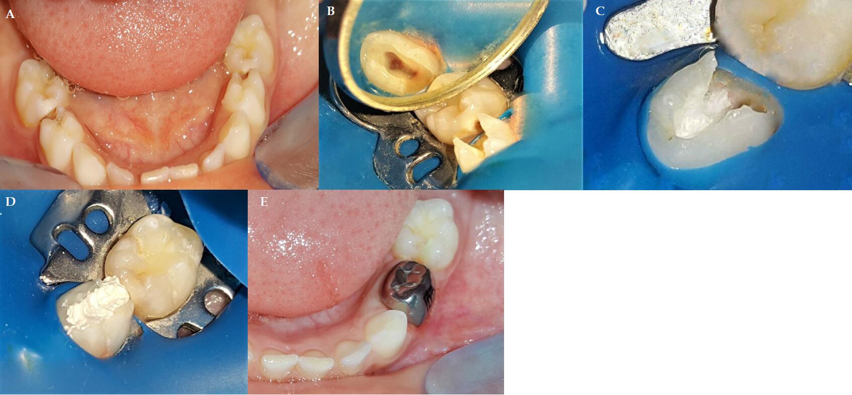 vital pulpotomy deciduous teeth